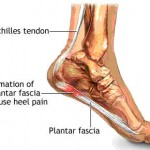 heel pain